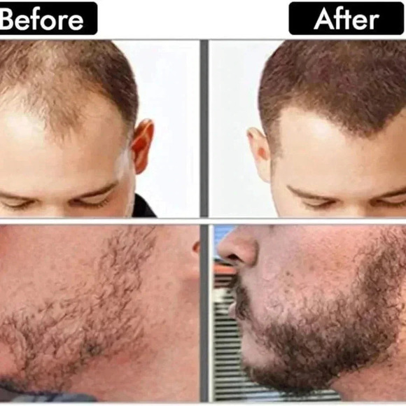 Beard derma rollers ! NWT - Picture 4 of 4